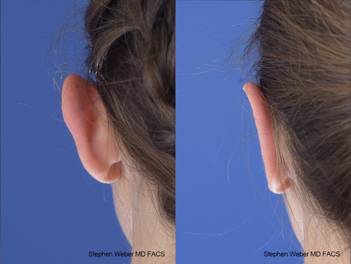 Otoplasty Before & After Gallery - Patient 253042 - Image 7