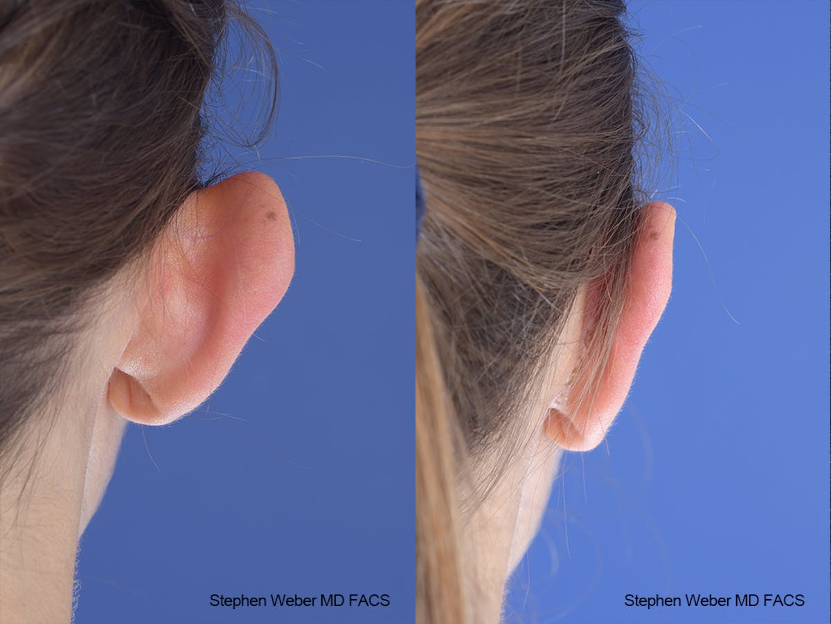 Otoplasty Before & After Gallery - Patient 253042 - Image 8
