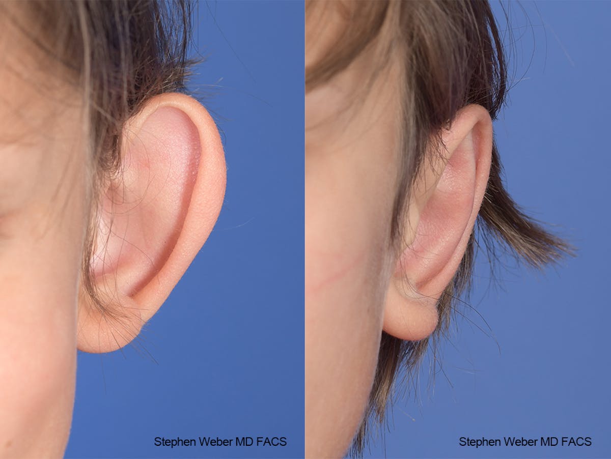 Otoplasty Before & After Gallery - Patient 179796 - Image 1