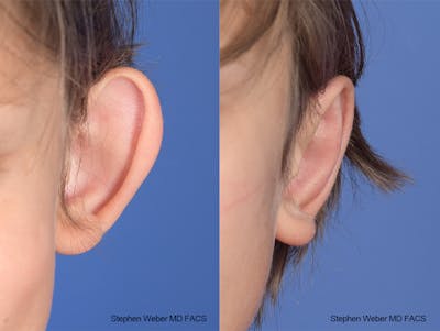 Otoplasty Before & After Gallery - Patient 179796 - Image 1