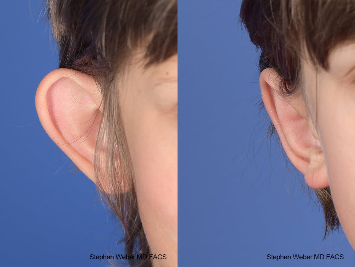 Otoplasty Before & After Gallery - Patient 179796 - Image 2