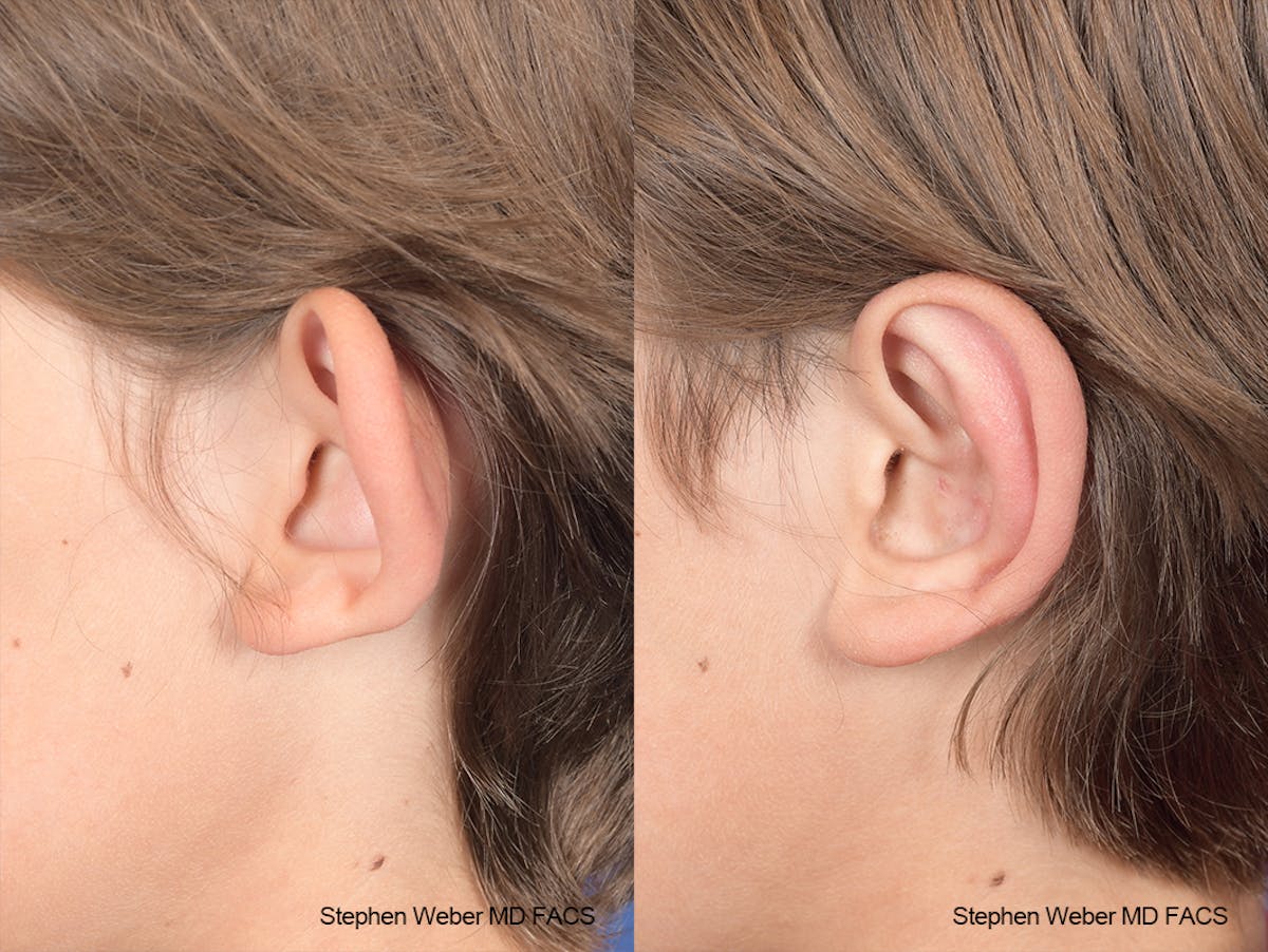 Otoplasty Before & After Gallery - Patient 179796 - Image 3
