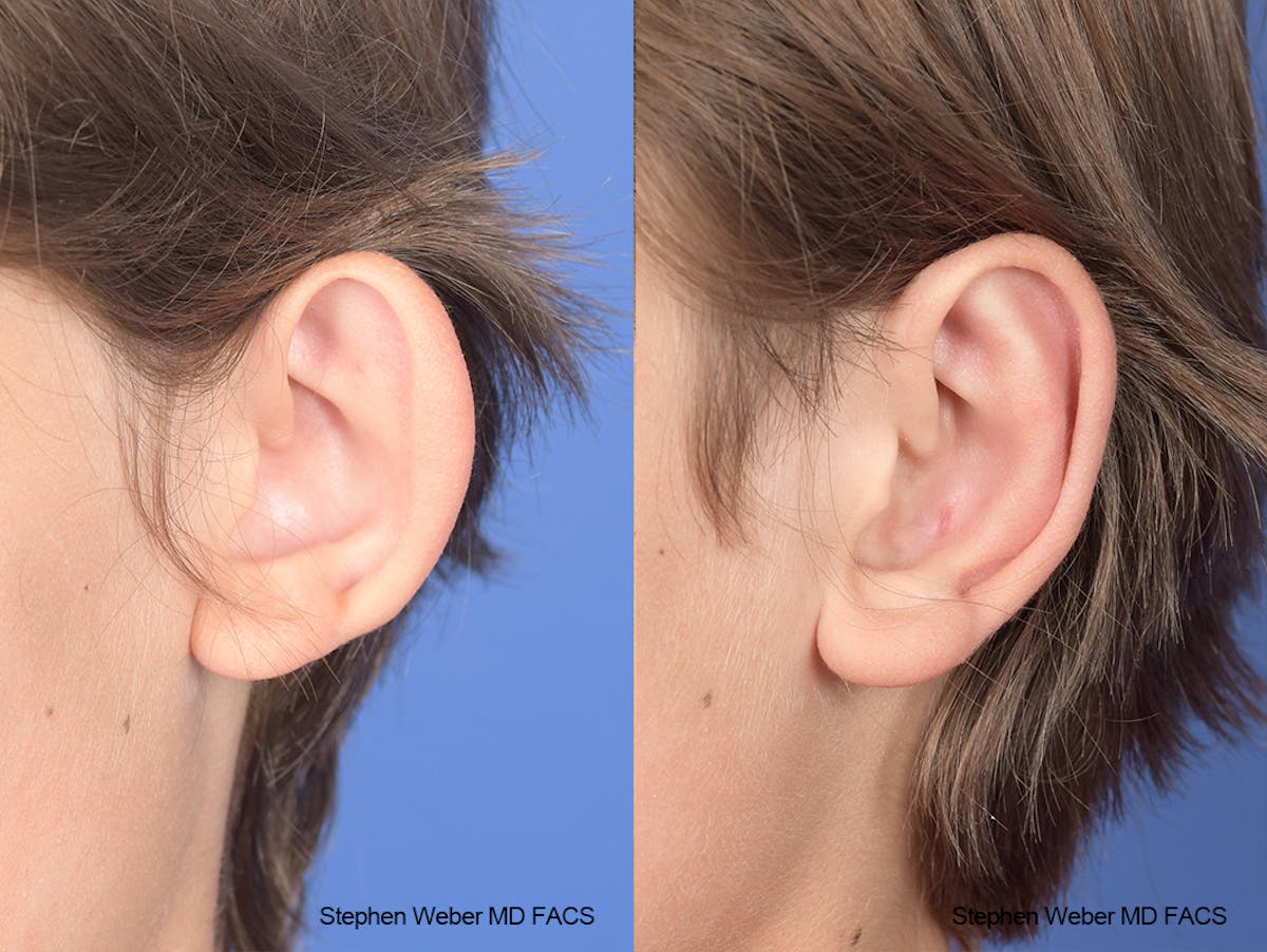 Otoplasty Before & After Gallery - Patient 179796 - Image 4