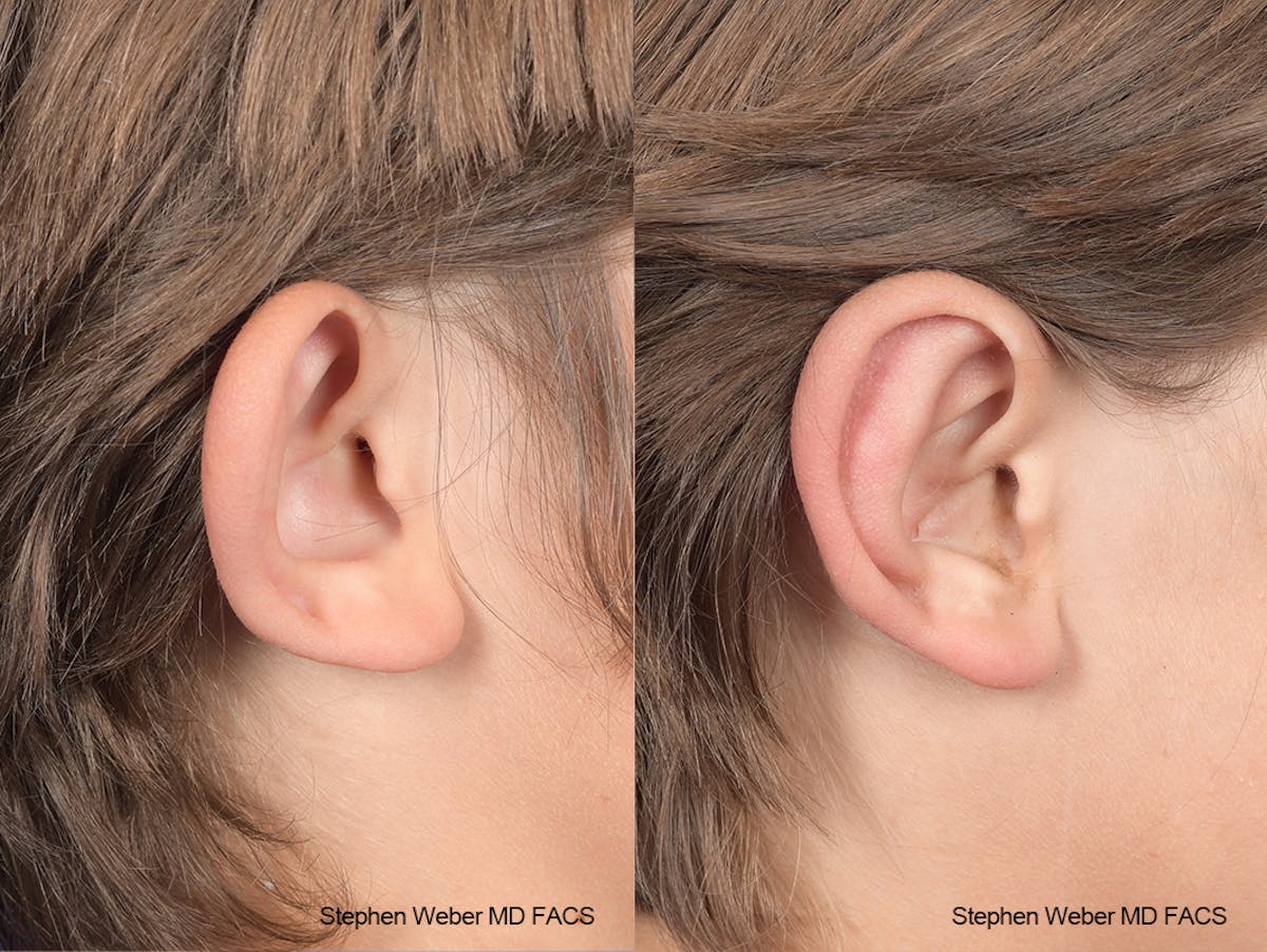 Otoplasty Before & After Gallery - Patient 179796 - Image 5