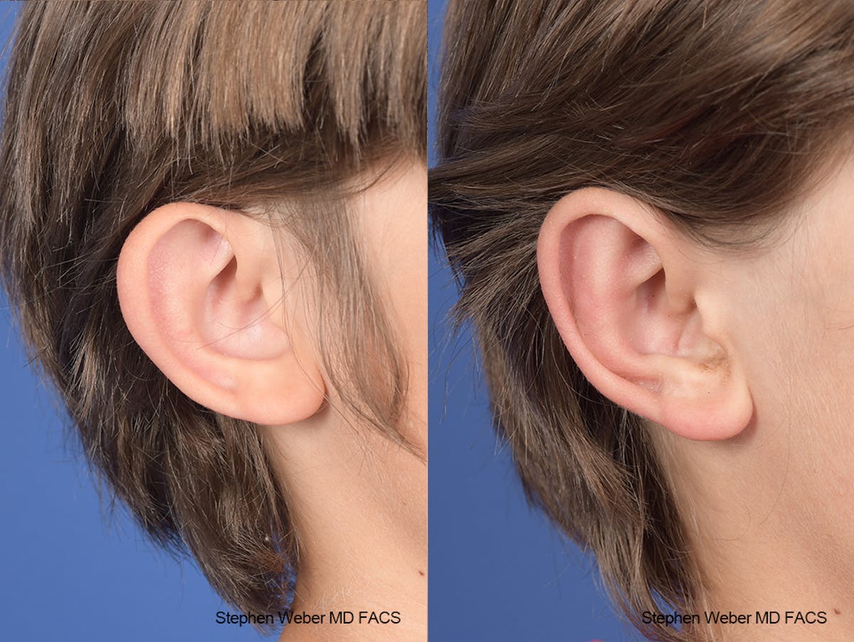 Otoplasty Before & After Gallery - Patient 179796 - Image 6