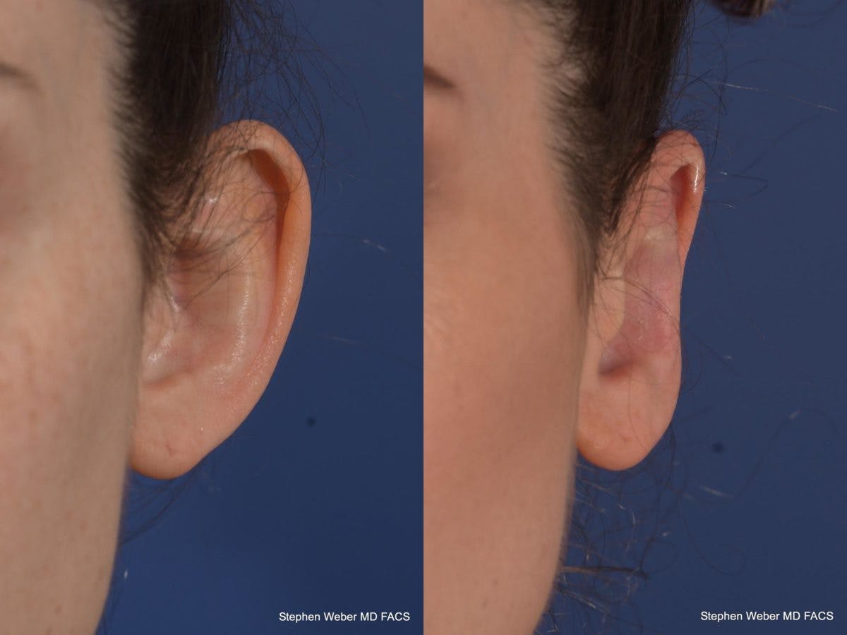 Otoplasty Before & After Gallery - Patient 294605 - Image 1