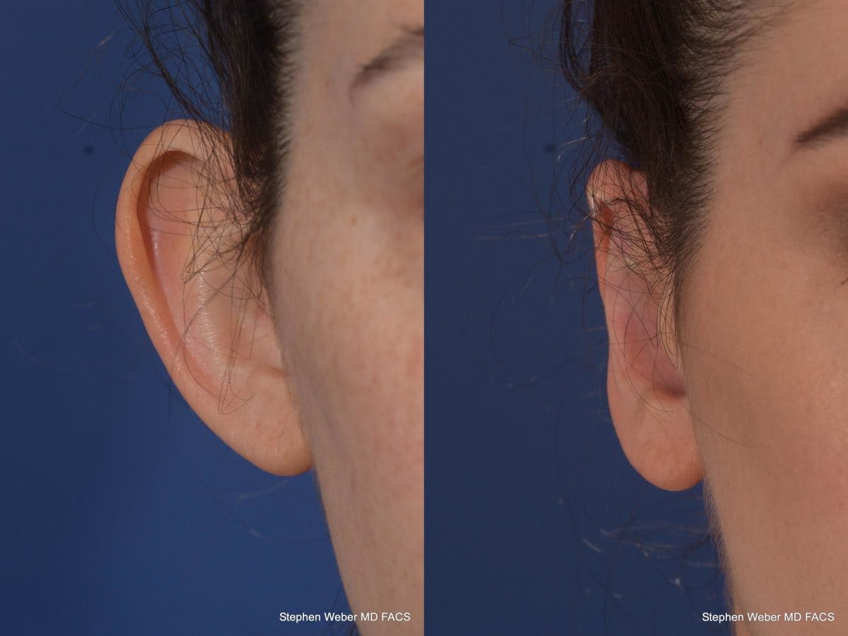Otoplasty Before & After Gallery - Patient 294605 - Image 2