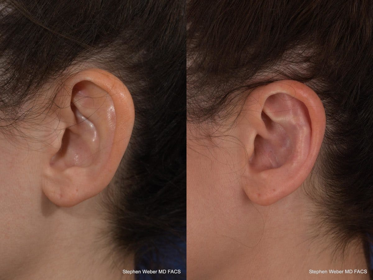Otoplasty Before & After Gallery - Patient 294605 - Image 3