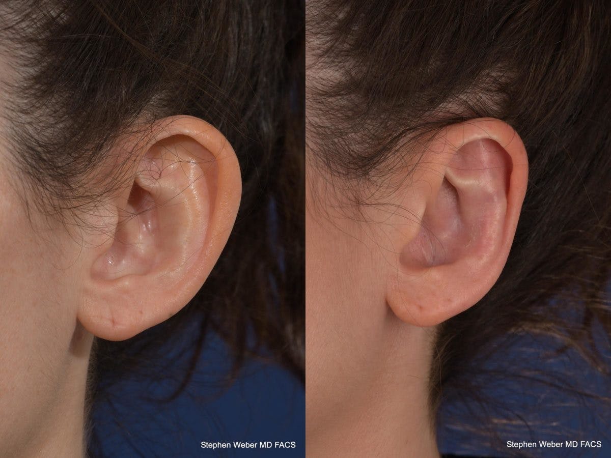 Otoplasty Before & After Gallery - Patient 294605 - Image 4