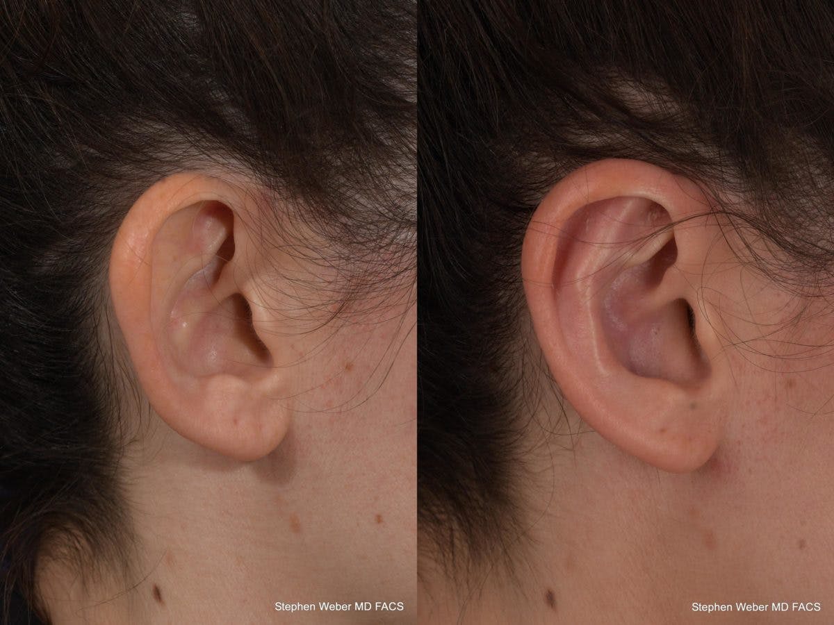 Otoplasty Before & After Gallery - Patient 294605 - Image 5
