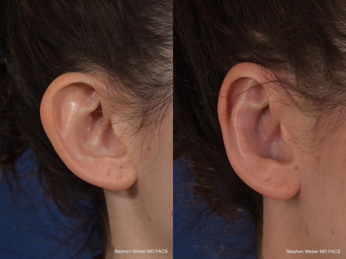 Otoplasty Before & After Gallery - Patient 294605 - Image 6