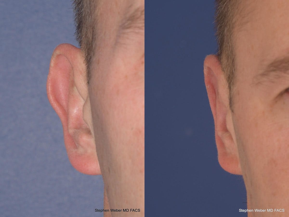 Otoplasty Before & After Gallery - Patient 218003 - Image 1