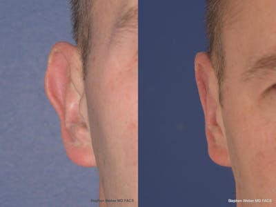Otoplasty Before & After Gallery - Patient 218003 - Image 1