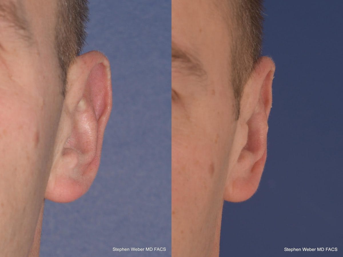 Otoplasty Before & After Gallery - Patient 218003 - Image 2