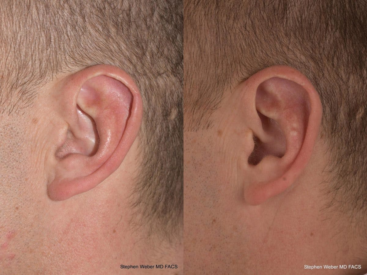 Otoplasty Before & After Gallery - Patient 218003 - Image 3