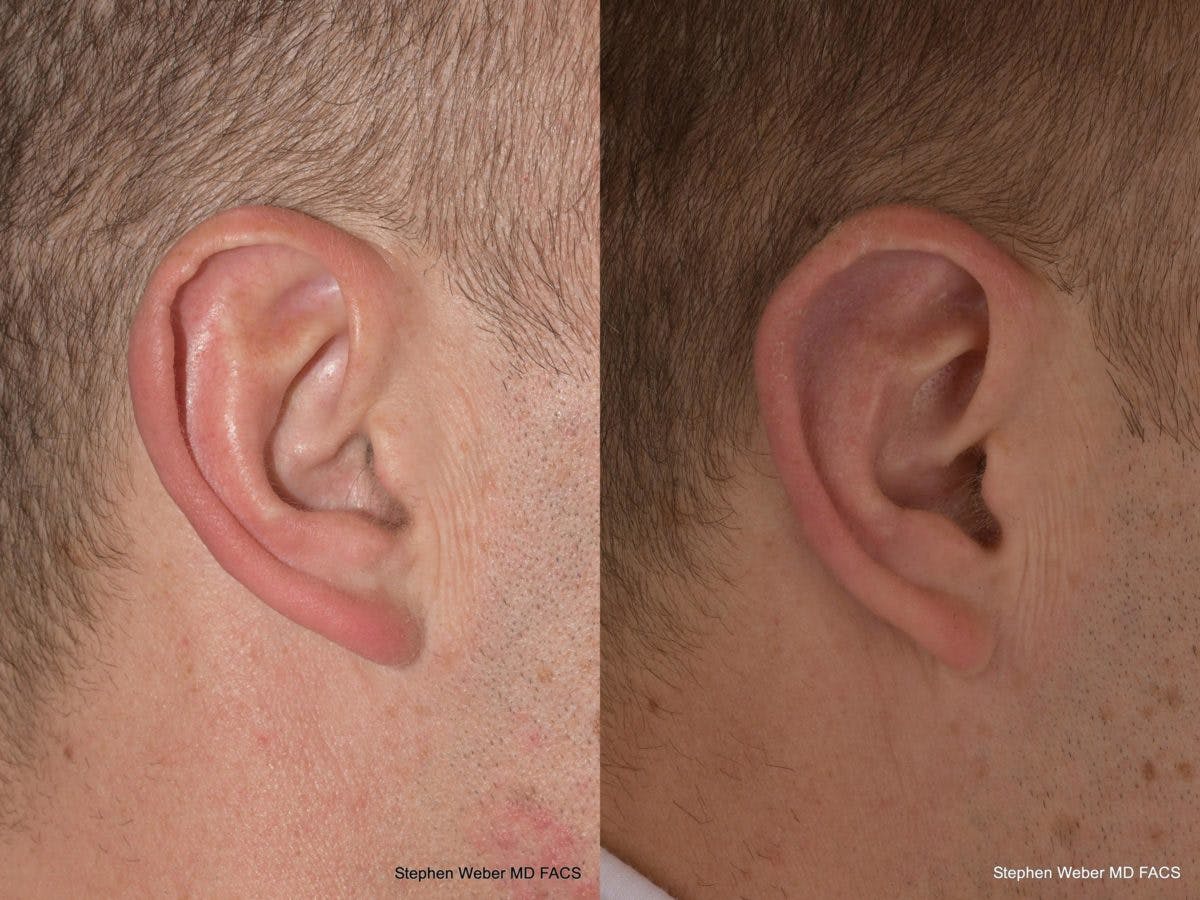 Otoplasty Before & After Gallery - Patient 218003 - Image 5