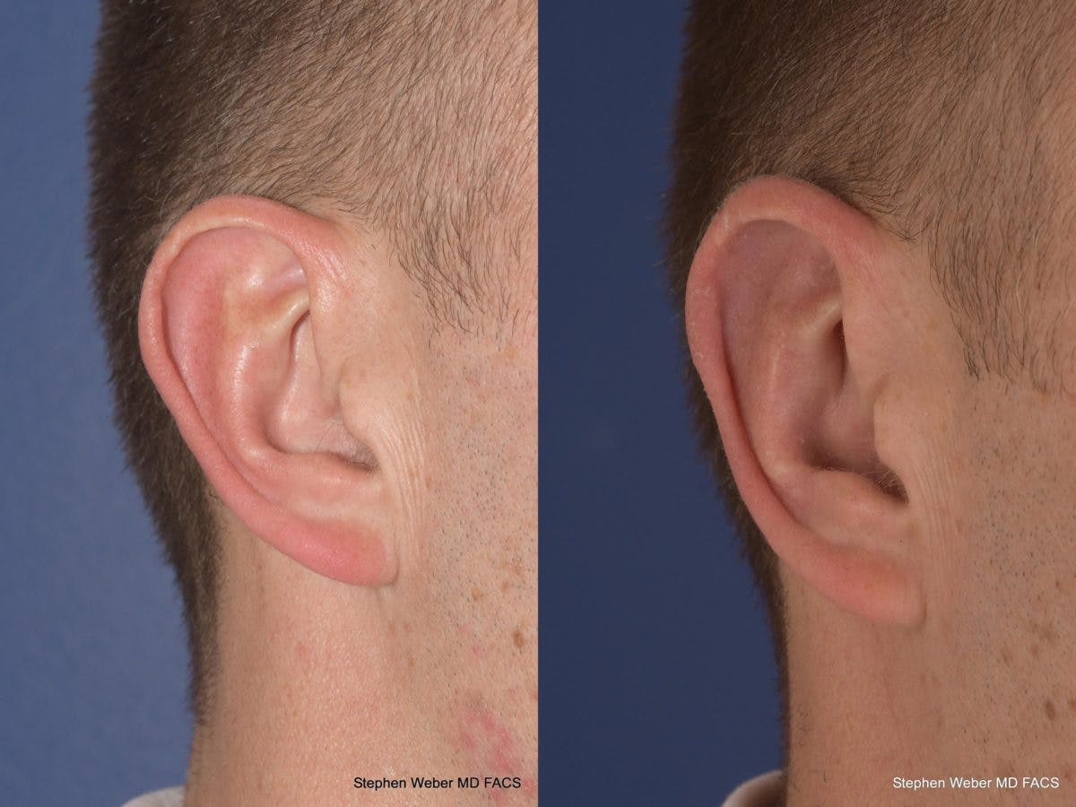 Otoplasty Before & After Gallery - Patient 218003 - Image 6