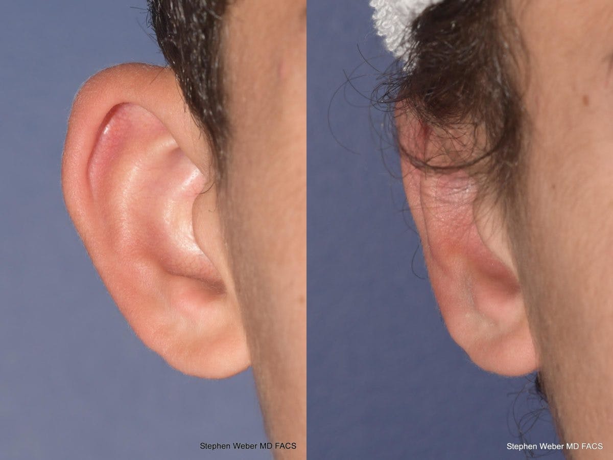 Otoplasty Before & After Gallery - Patient 394564 - Image 1
