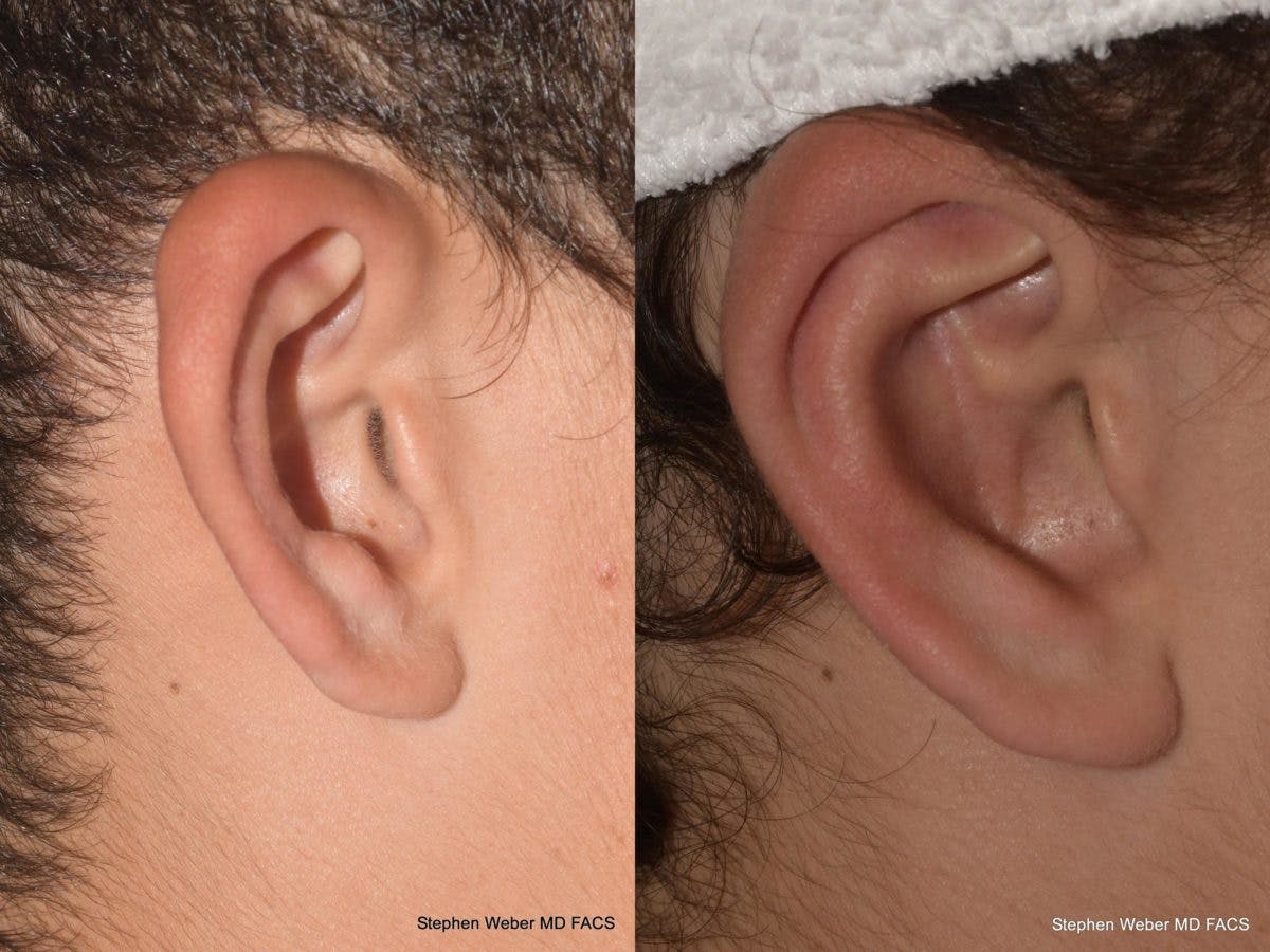 Otoplasty Before & After Gallery - Patient 394564 - Image 2
