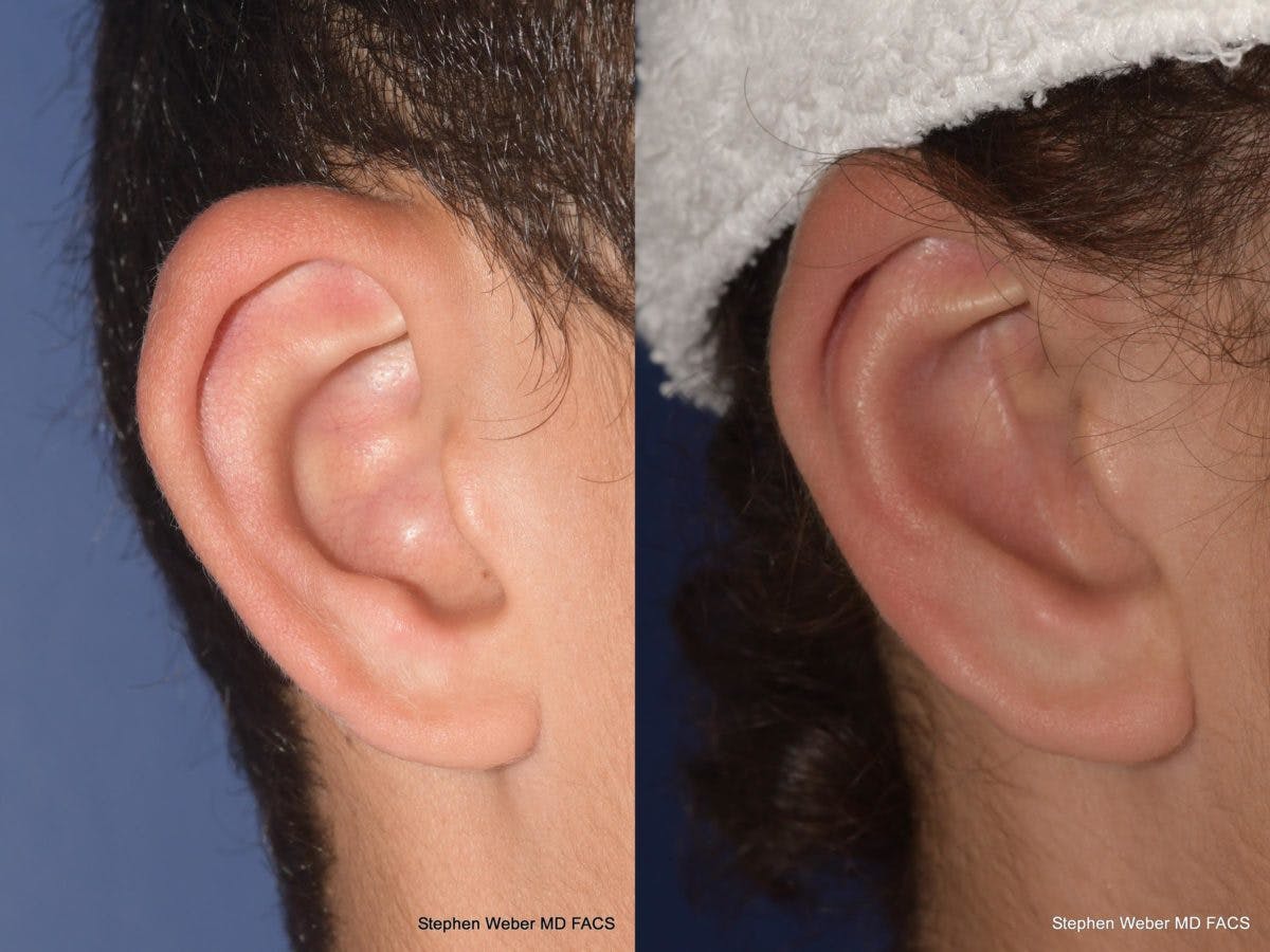 Otoplasty Before & After Gallery - Patient 394564 - Image 3