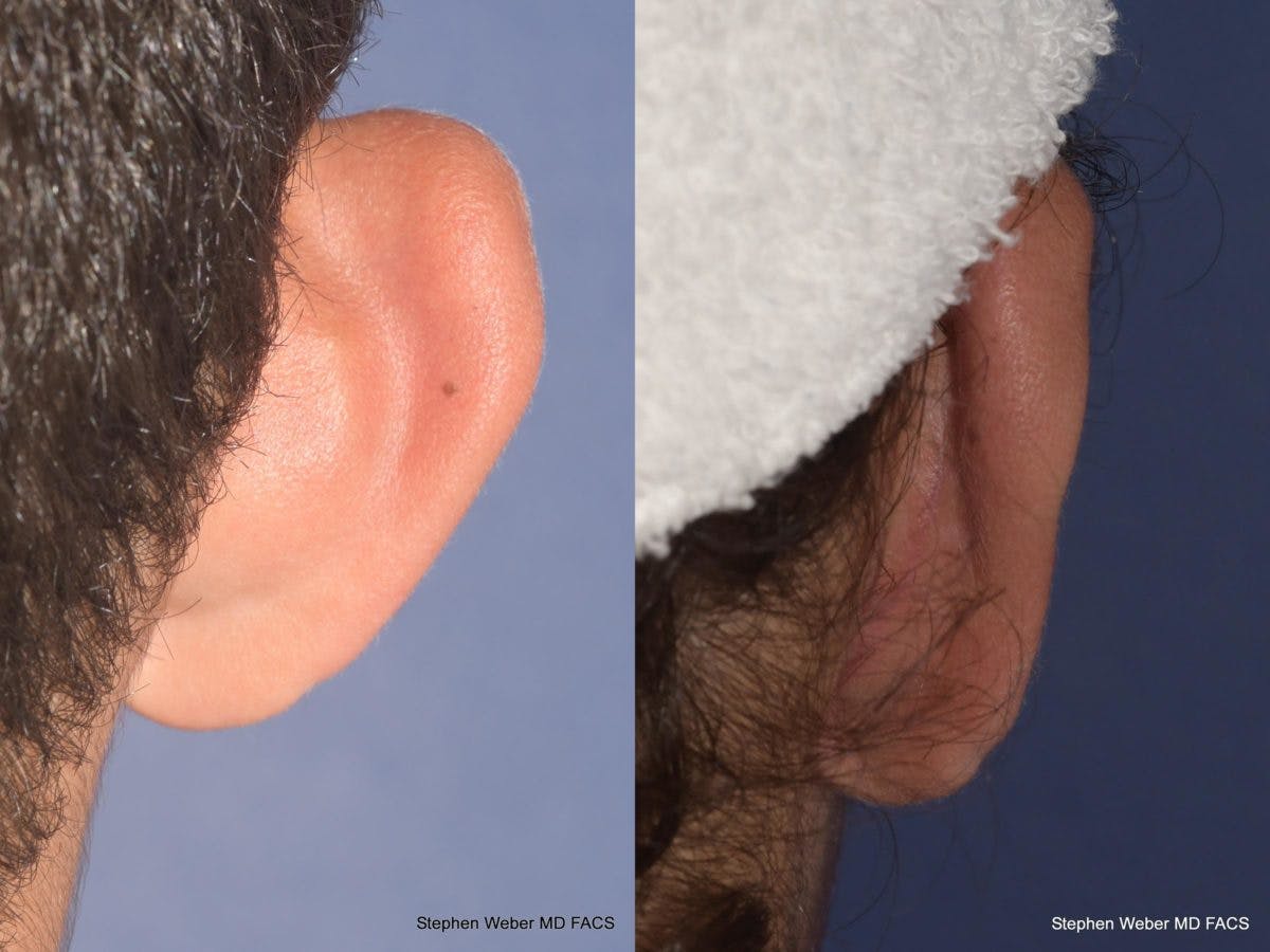 Otoplasty Before & After Gallery - Patient 394564 - Image 4