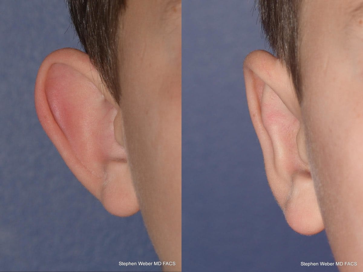 Otoplasty Before & After Gallery - Patient 359092 - Image 1