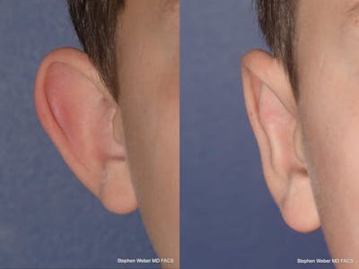 Otoplasty Before & After Gallery - Patient 359092 - Image 1
