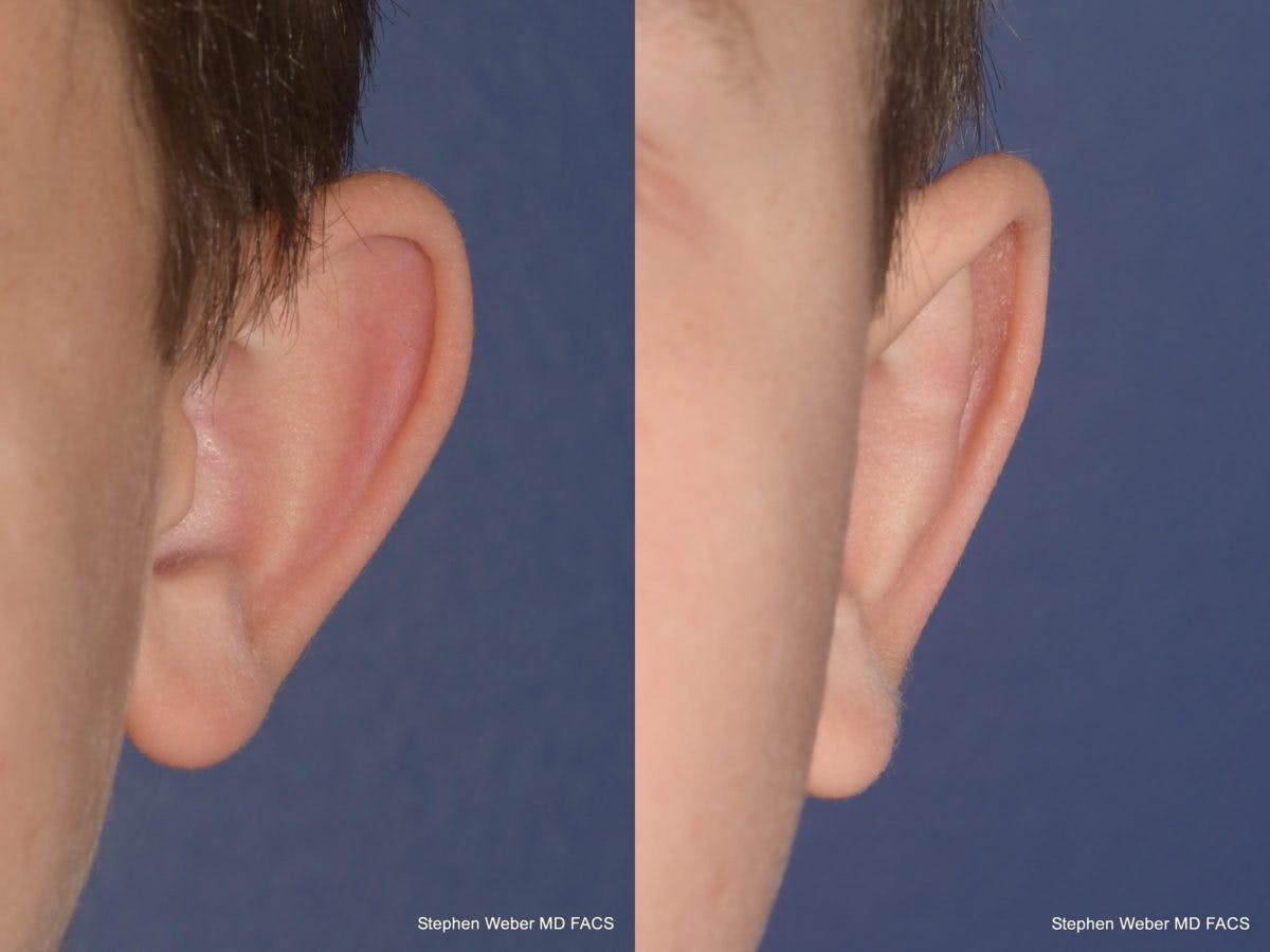 Otoplasty Before & After Gallery - Patient 359092 - Image 2