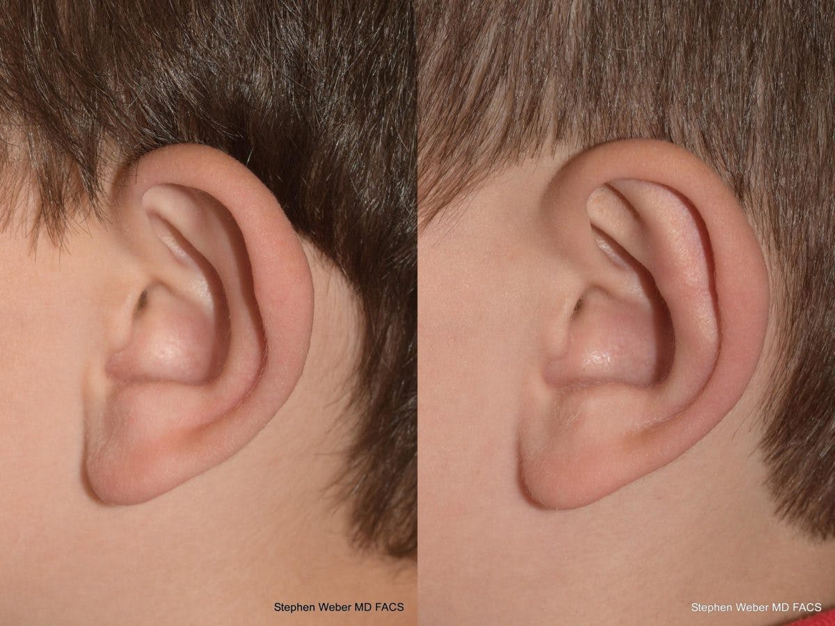 Otoplasty Before & After Gallery - Patient 359092 - Image 3