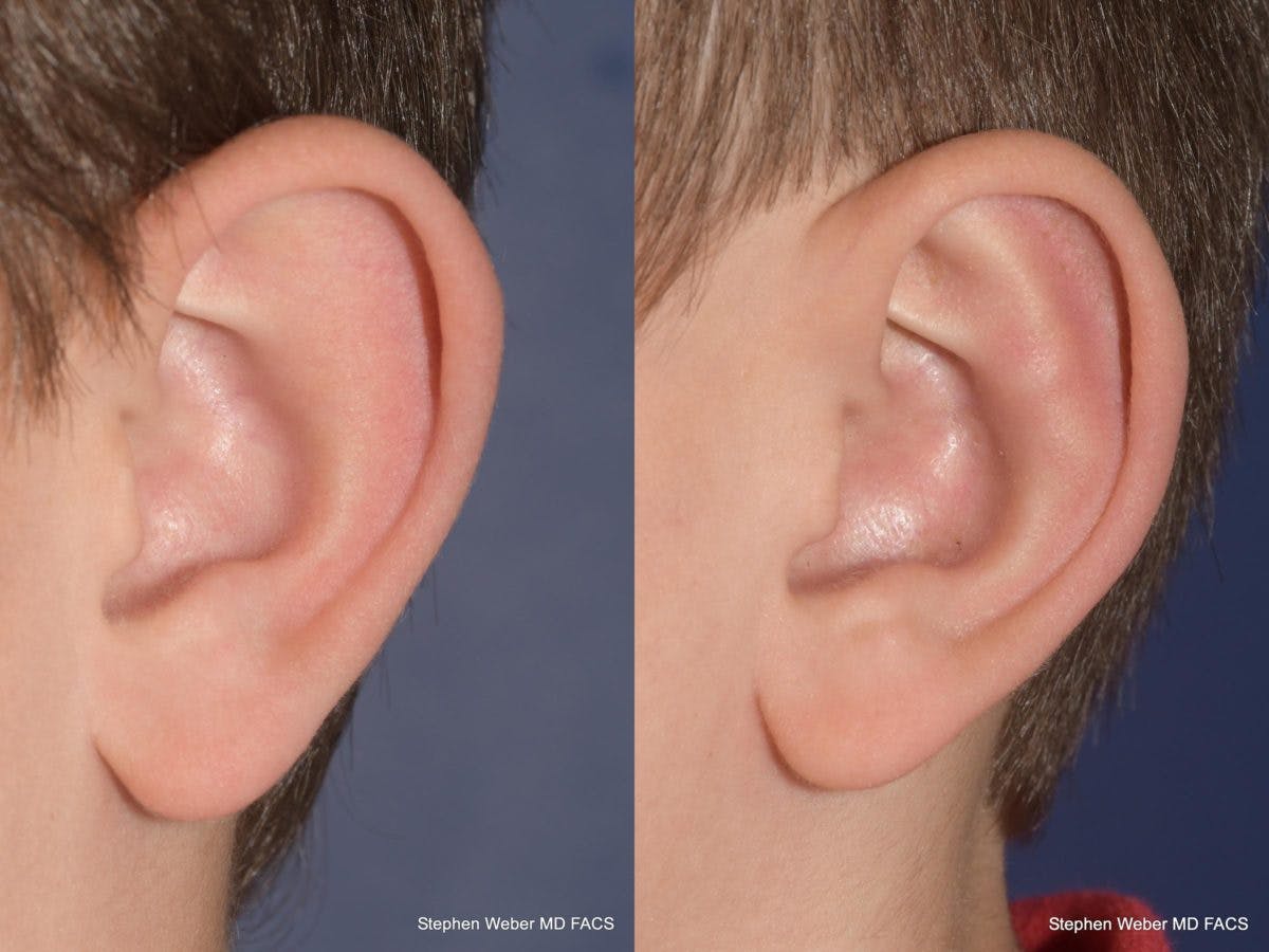 Otoplasty Before & After Gallery - Patient 359092 - Image 4