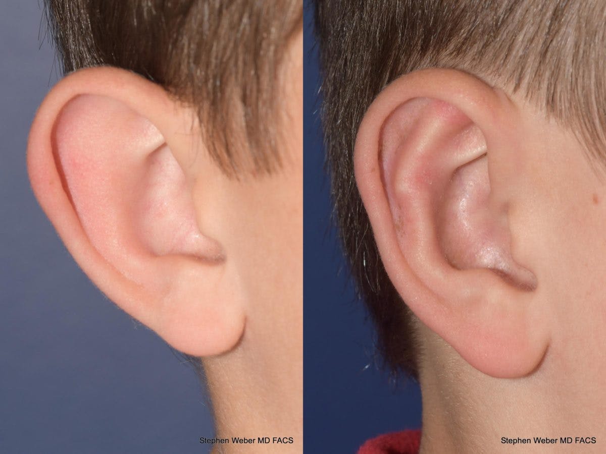 Otoplasty Before & After Gallery - Patient 359092 - Image 5