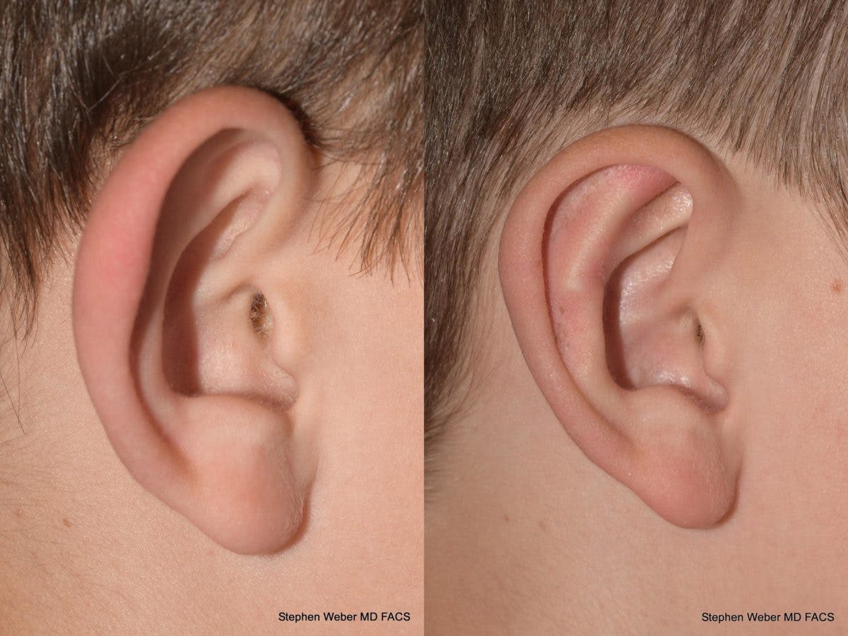 Otoplasty Before & After Gallery - Patient 359092 - Image 6