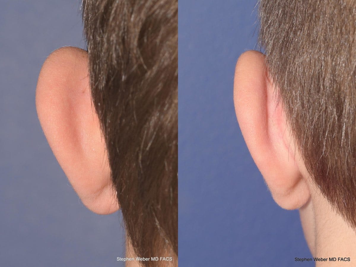 Otoplasty Before & After Gallery - Patient 359092 - Image 7