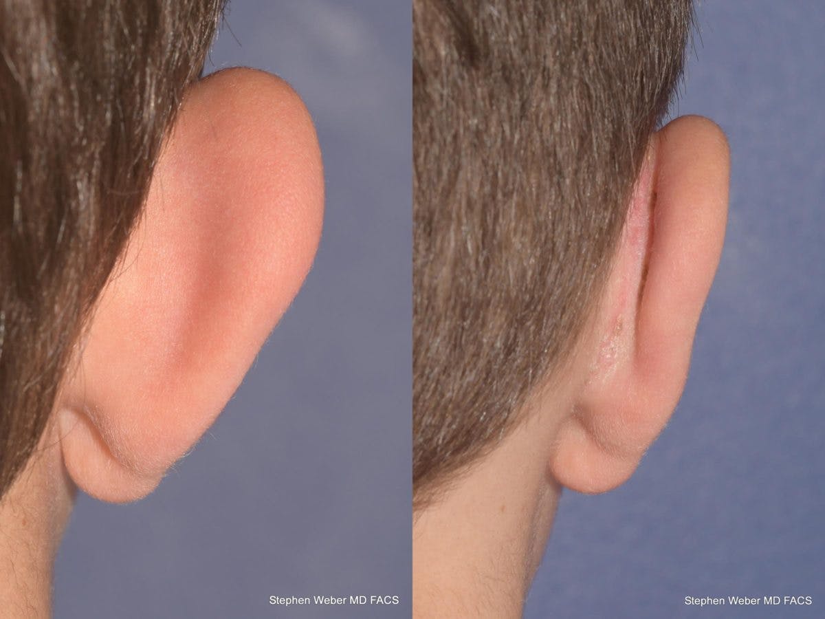 Otoplasty Before & After Gallery - Patient 359092 - Image 8