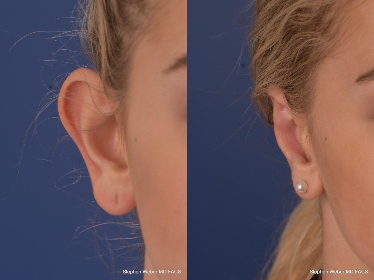 Otoplasty Before & After Gallery - Patient 279071 - Image 1