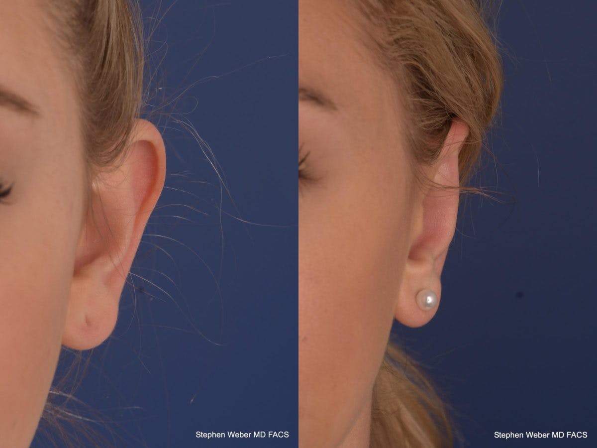 Otoplasty Before & After Gallery - Patient 279071 - Image 2