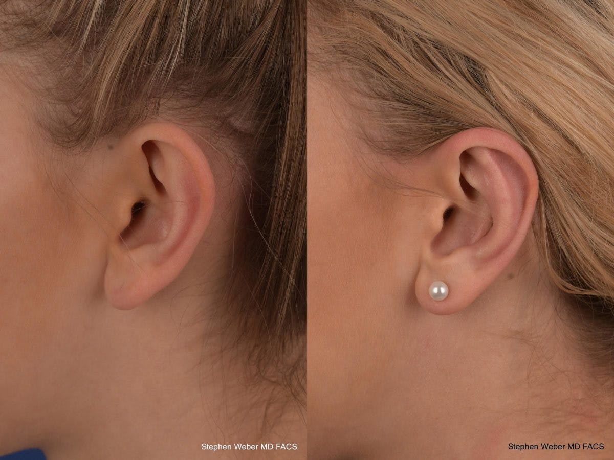 Otoplasty Before & After Gallery - Patient 279071 - Image 3