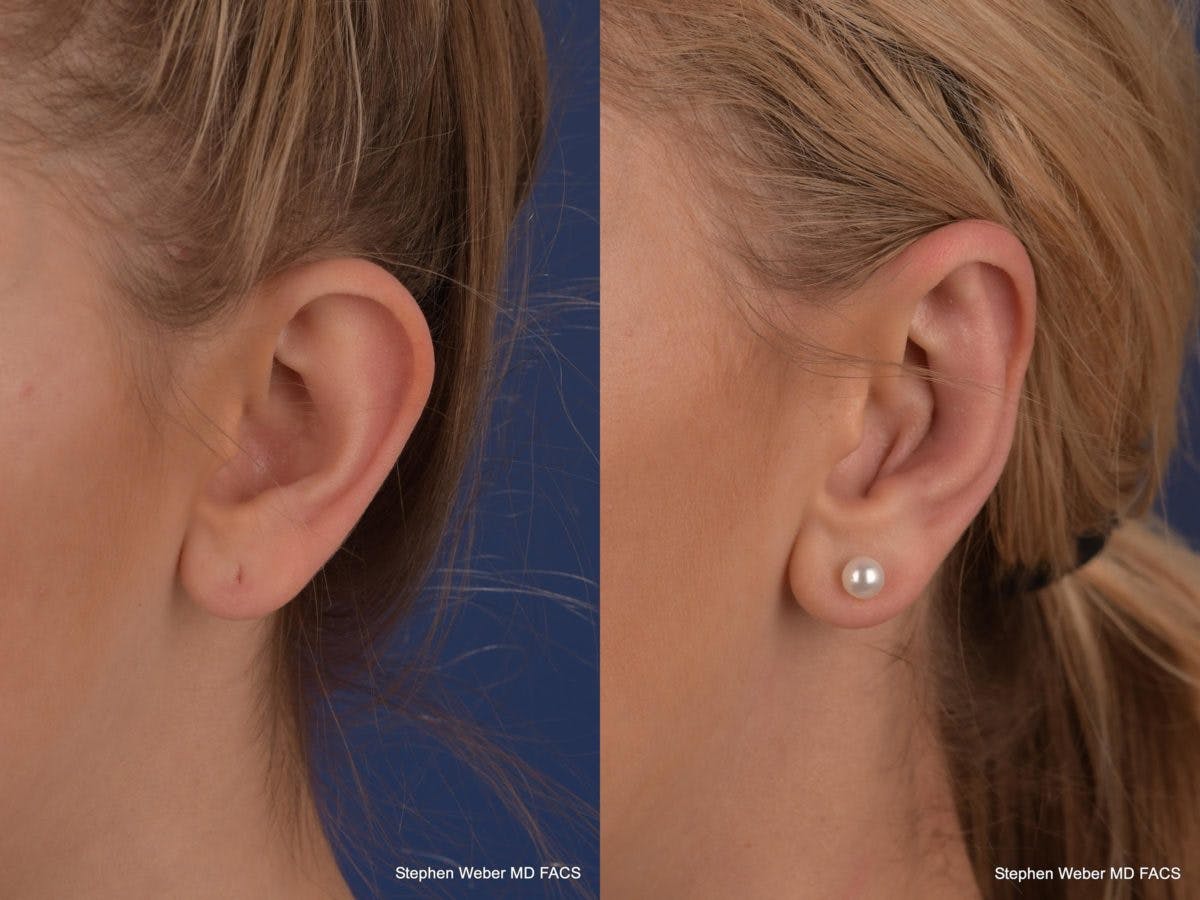 Otoplasty Before & After Gallery - Patient 279071 - Image 4