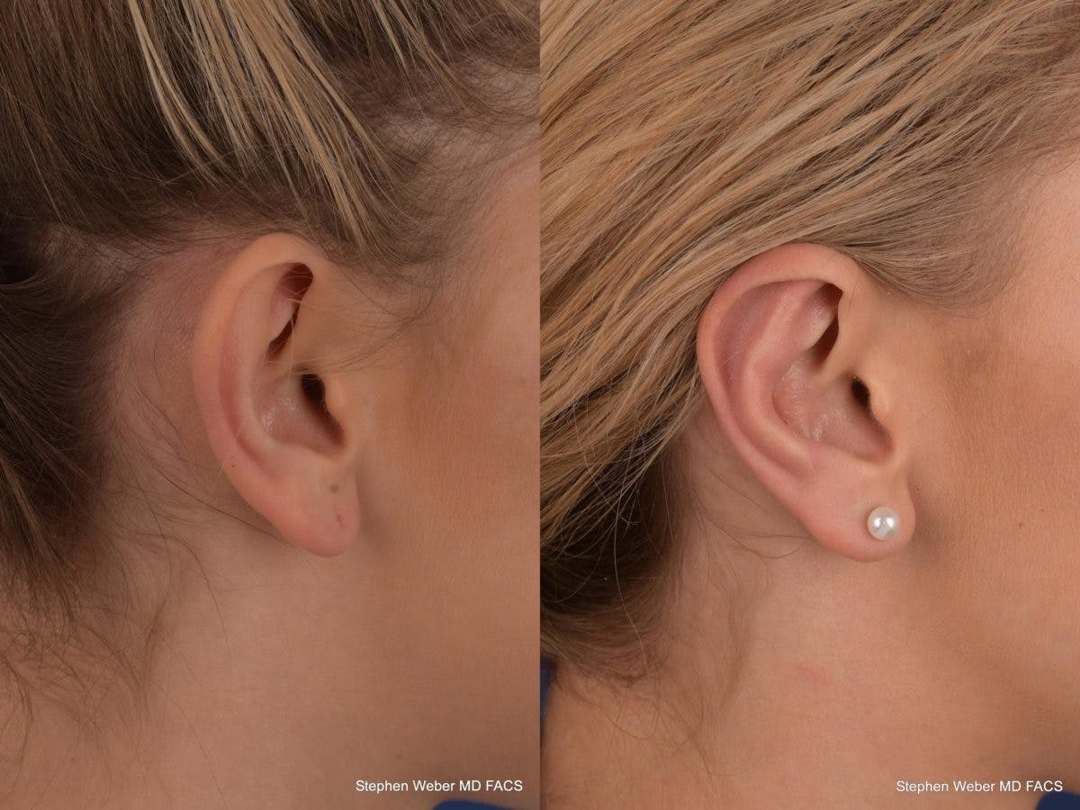 Otoplasty Before & After Gallery - Patient 279071 - Image 5