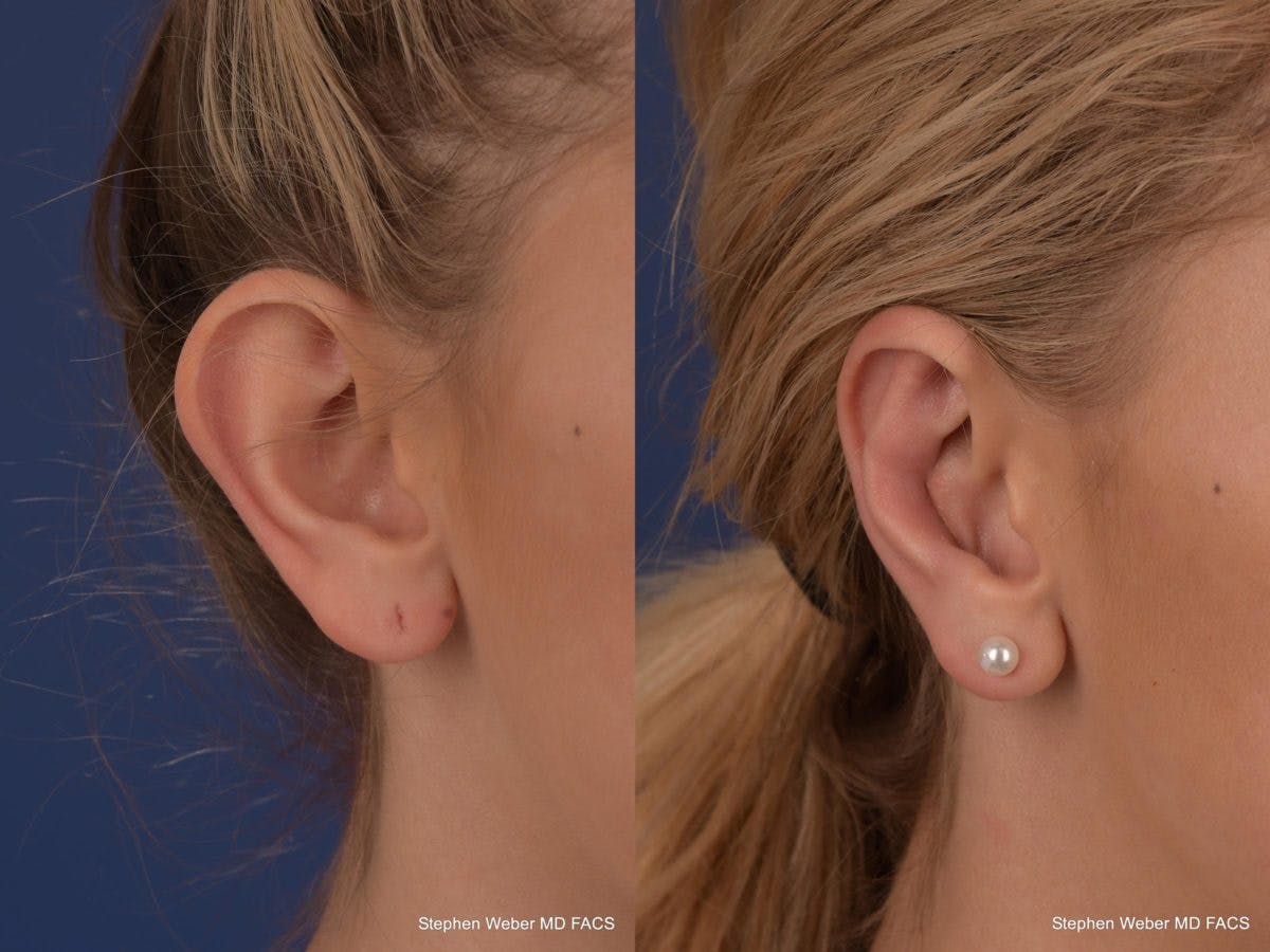 Otoplasty Before & After Gallery - Patient 279071 - Image 6