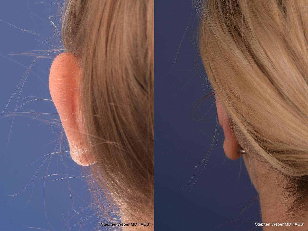 Otoplasty Before & After Gallery - Patient 279071 - Image 7