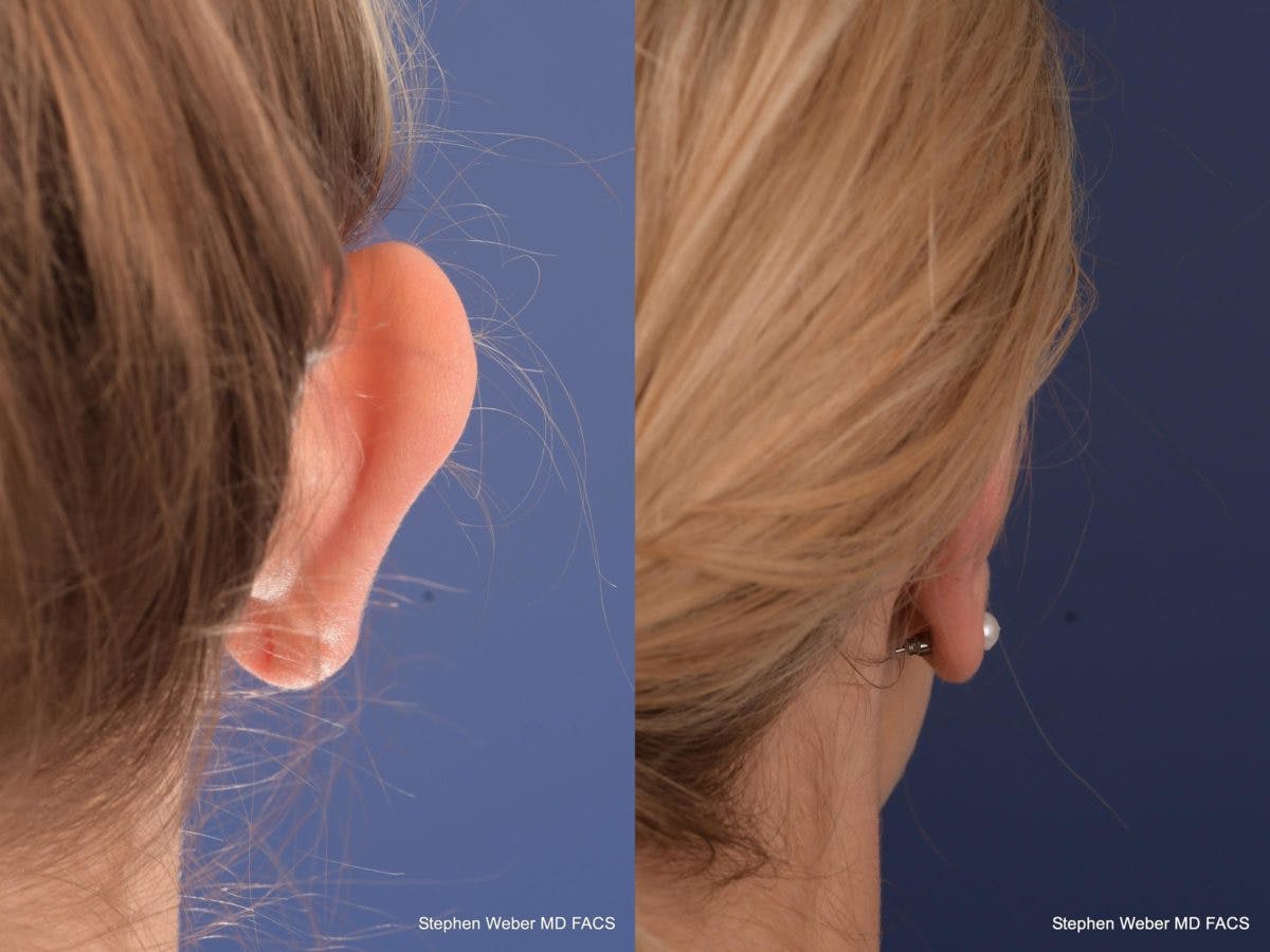 Otoplasty Before & After Gallery - Patient 279071 - Image 8