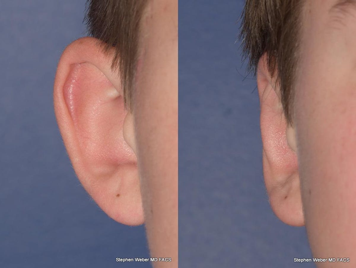 Otoplasty Before & After Gallery - Patient 294886 - Image 1