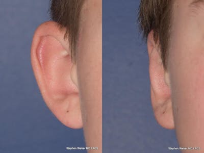 Otoplasty Before & After Gallery - Patient 294886 - Image 1