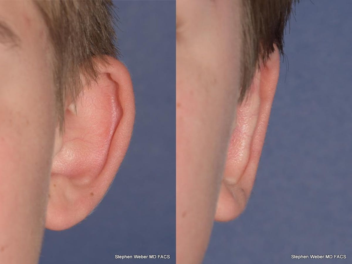 Otoplasty Before & After Gallery - Patient 294886 - Image 2