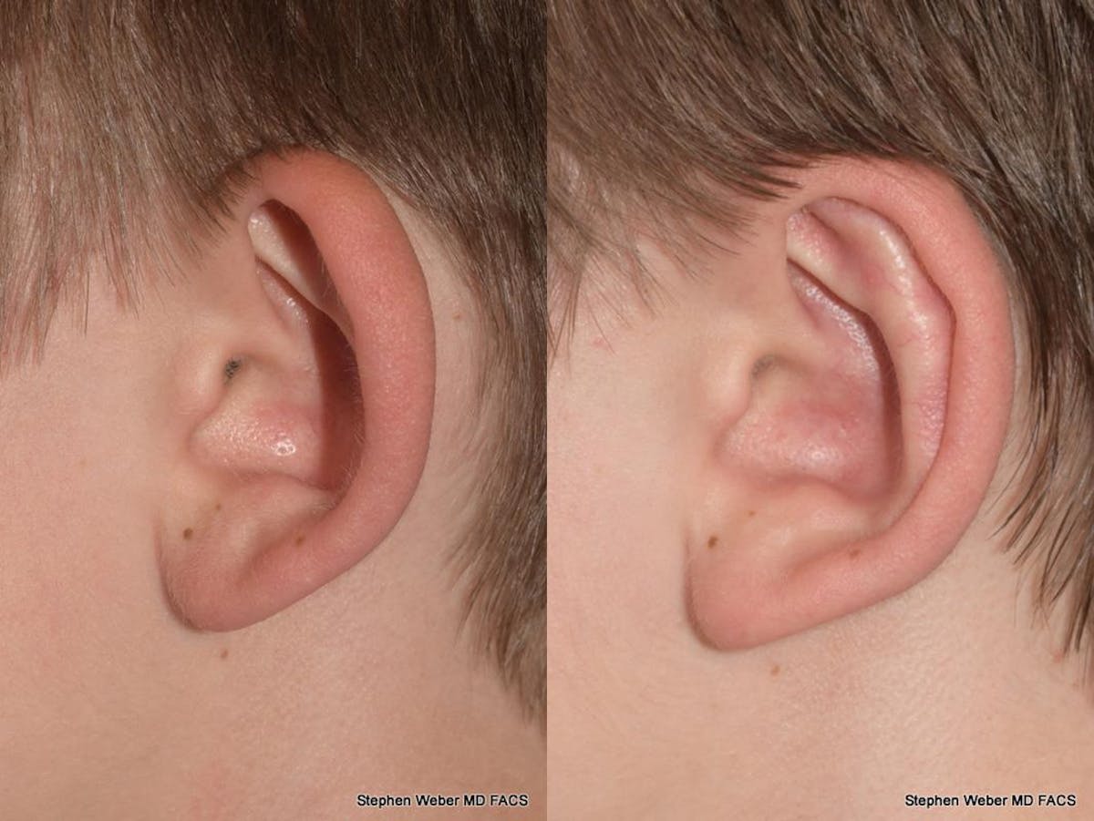 Otoplasty Before & After Gallery - Patient 294886 - Image 3