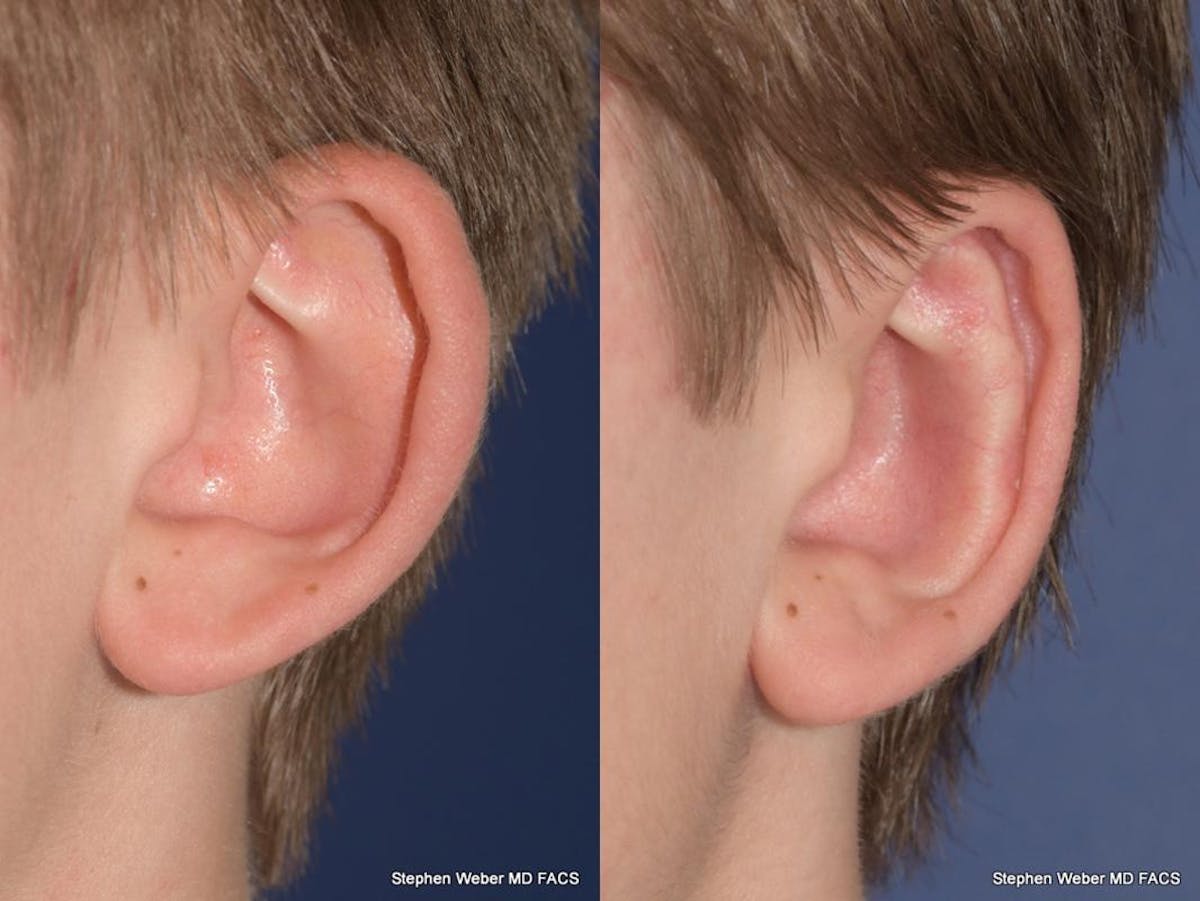 Otoplasty Before & After Gallery - Patient 294886 - Image 4