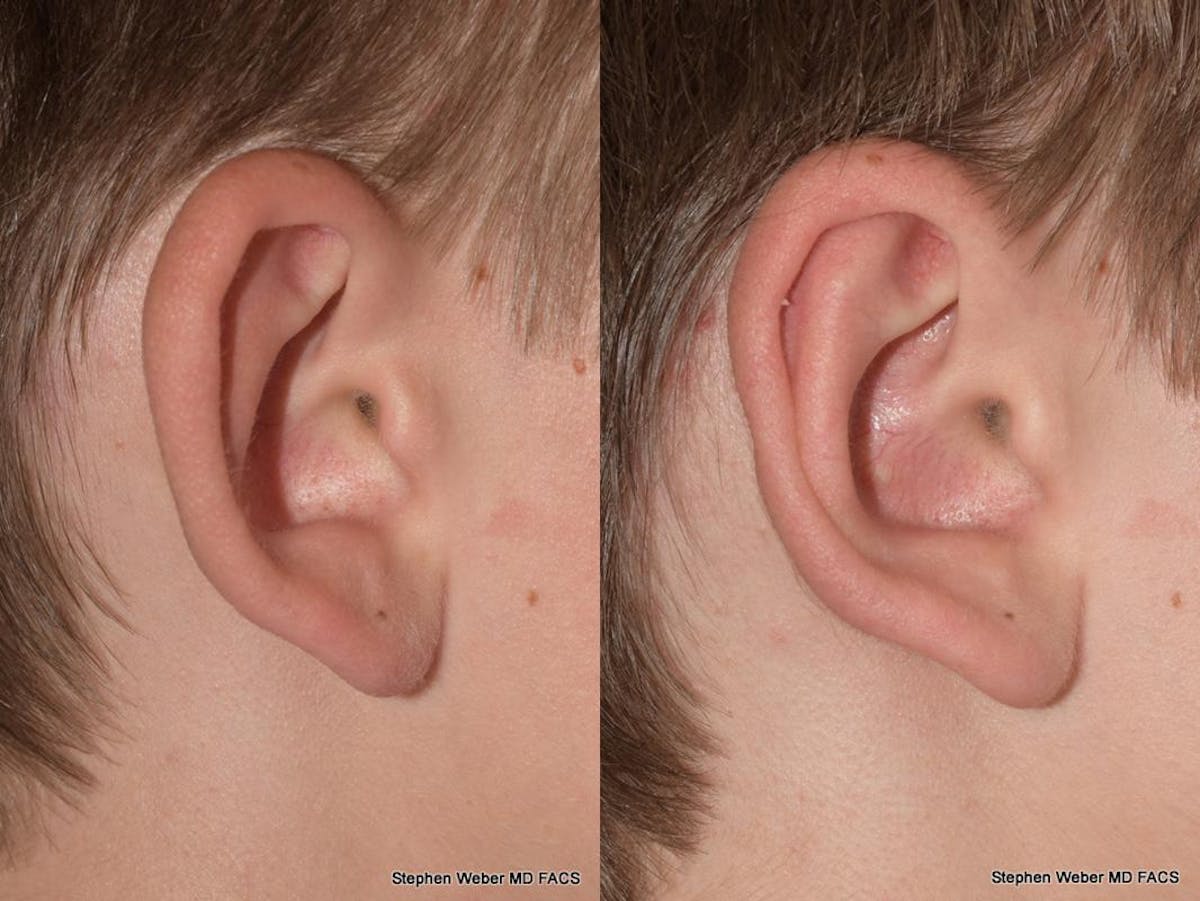 Otoplasty Before & After Gallery - Patient 294886 - Image 5