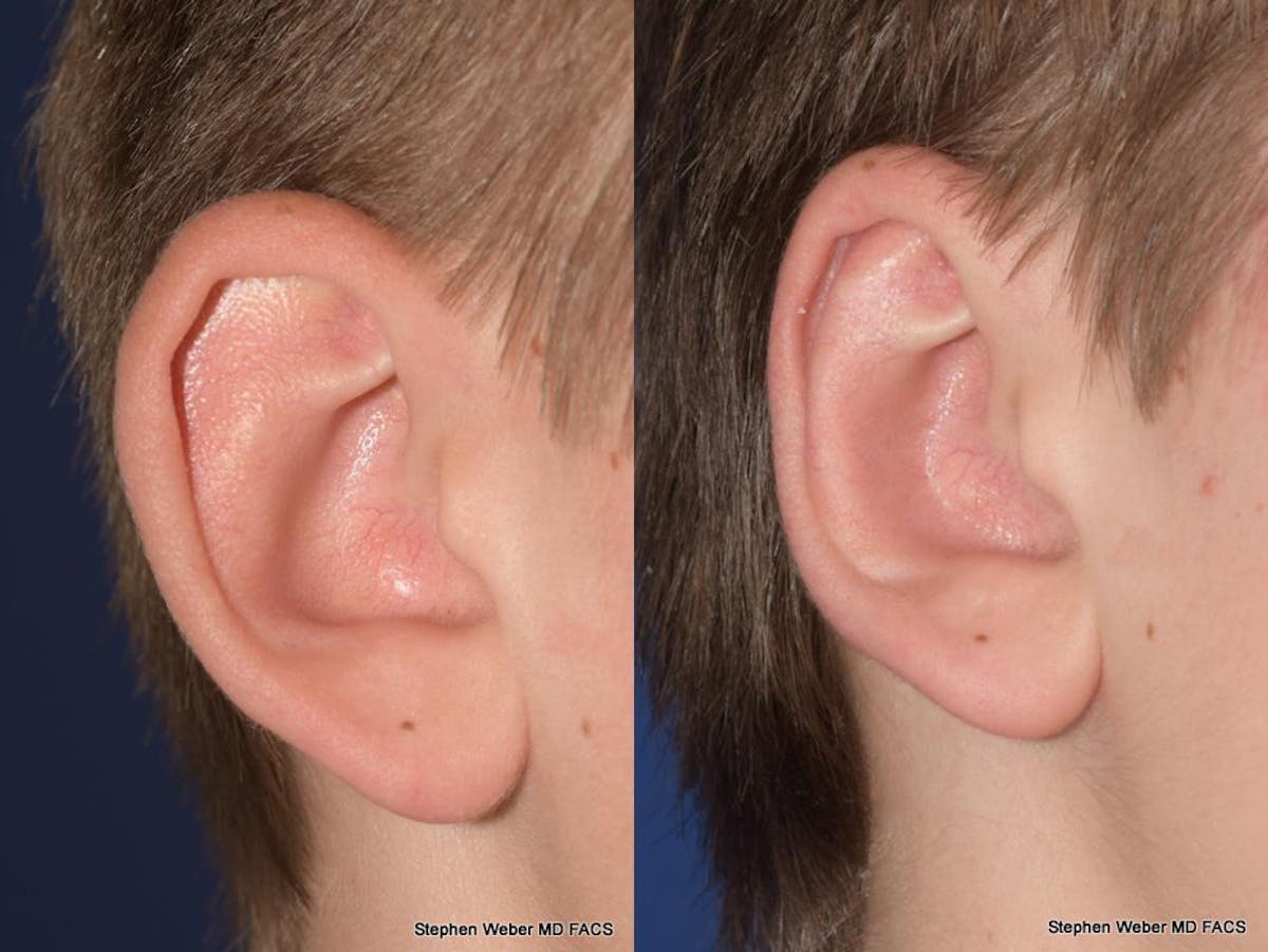 Otoplasty Before & After Gallery - Patient 294886 - Image 6