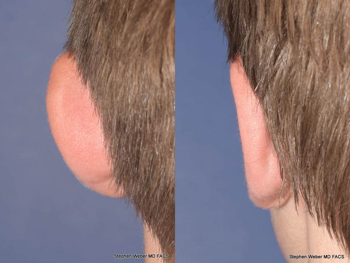 Otoplasty Before & After Gallery - Patient 294886 - Image 7